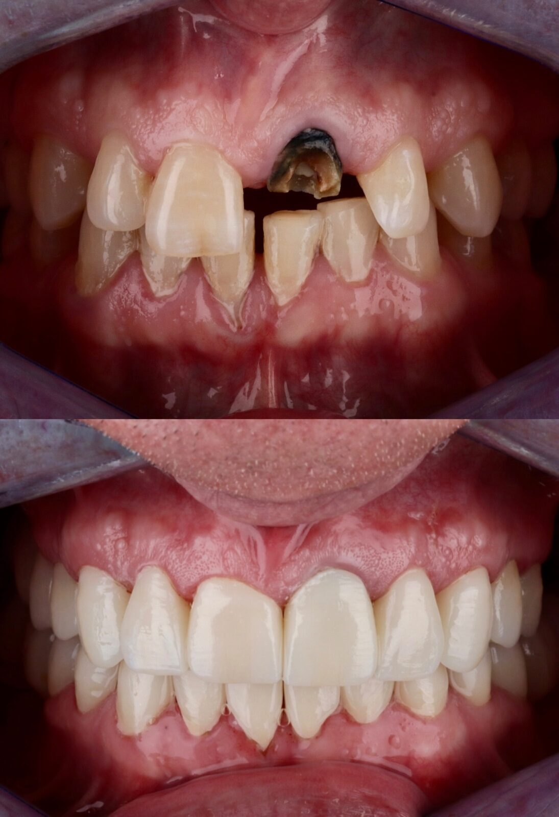 Before and after front teeth restoration with crowns at Tooth Implant Co. in Los Algodones, Mexico