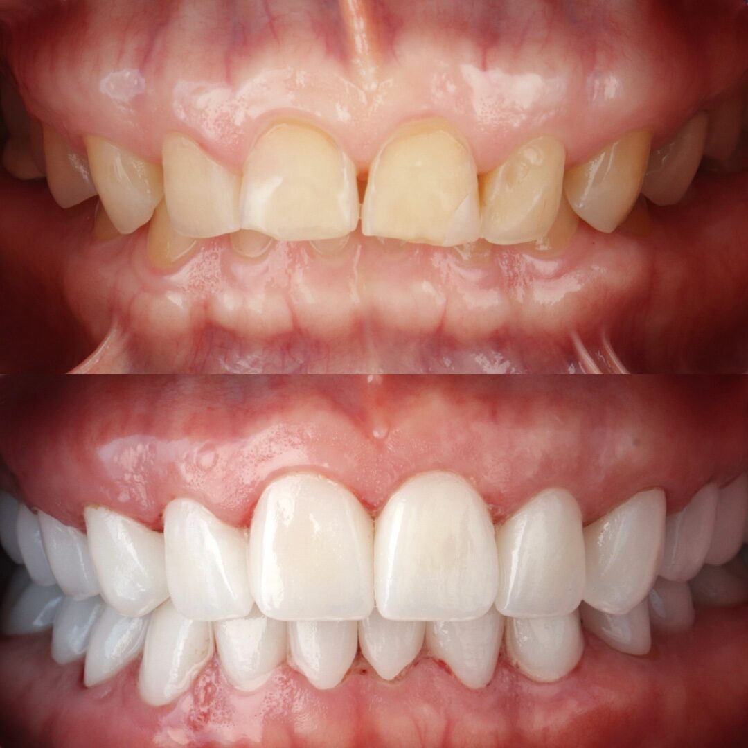 Before and after full smile makeover with porcelain veneers and crowns in Los Algodones, Mexico