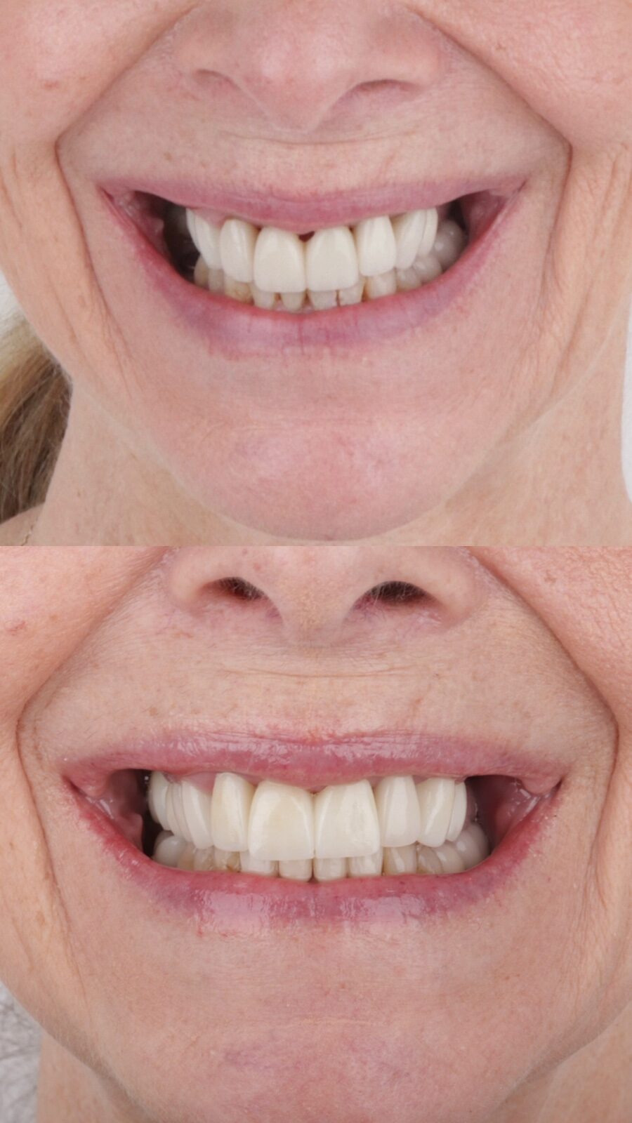 Before and after smile refresh with new crowns at Tooth Implant Co. in Los Algodones, Mexico