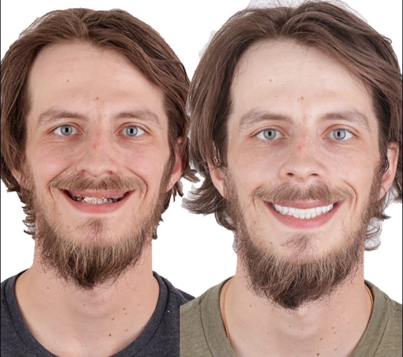 Before and after complete smile transformation at Tooth Implant Co. in Los Algodones, Mexico